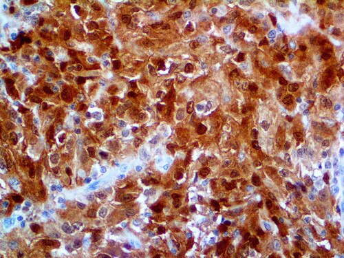 IHC of Calretinin on an FFPE Mesothelioma Tissue
